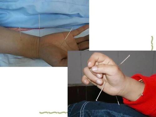 成人针刺针法视频大全,全面掌握针灸技巧与实操解析